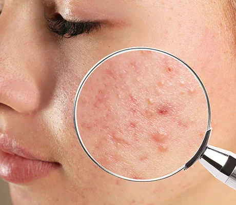 16 Dos and don’ts for oily, acne-prone skin