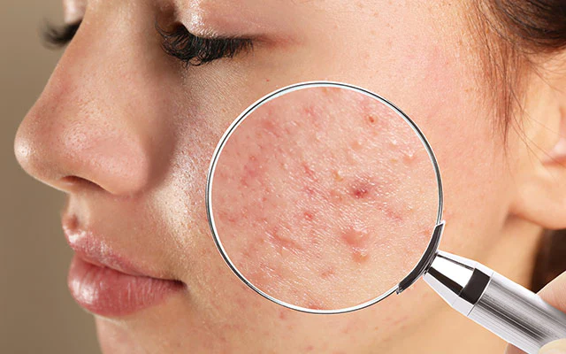 16 Dos and don’ts for oily, acne-prone skin